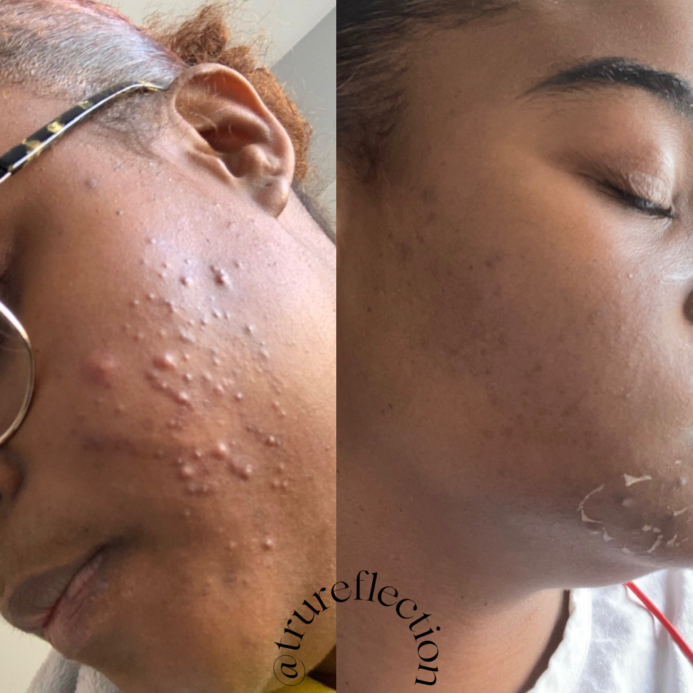 Utra Peel