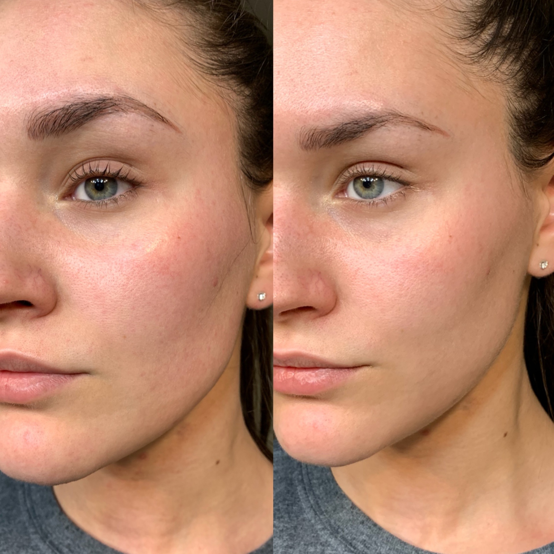 VAMP PDRN at Avidan Med Spa in Warwick, NY