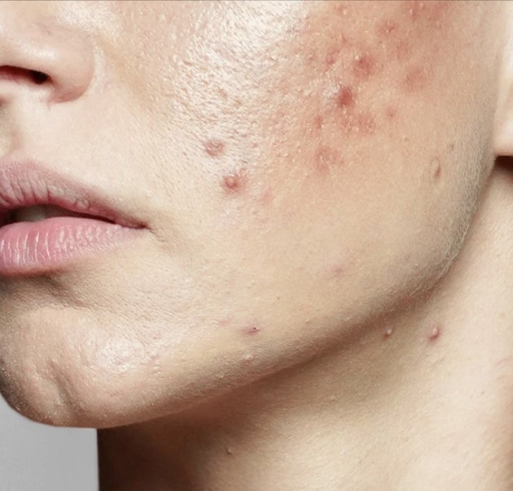 Acne Bootcamp 3 Month Package
