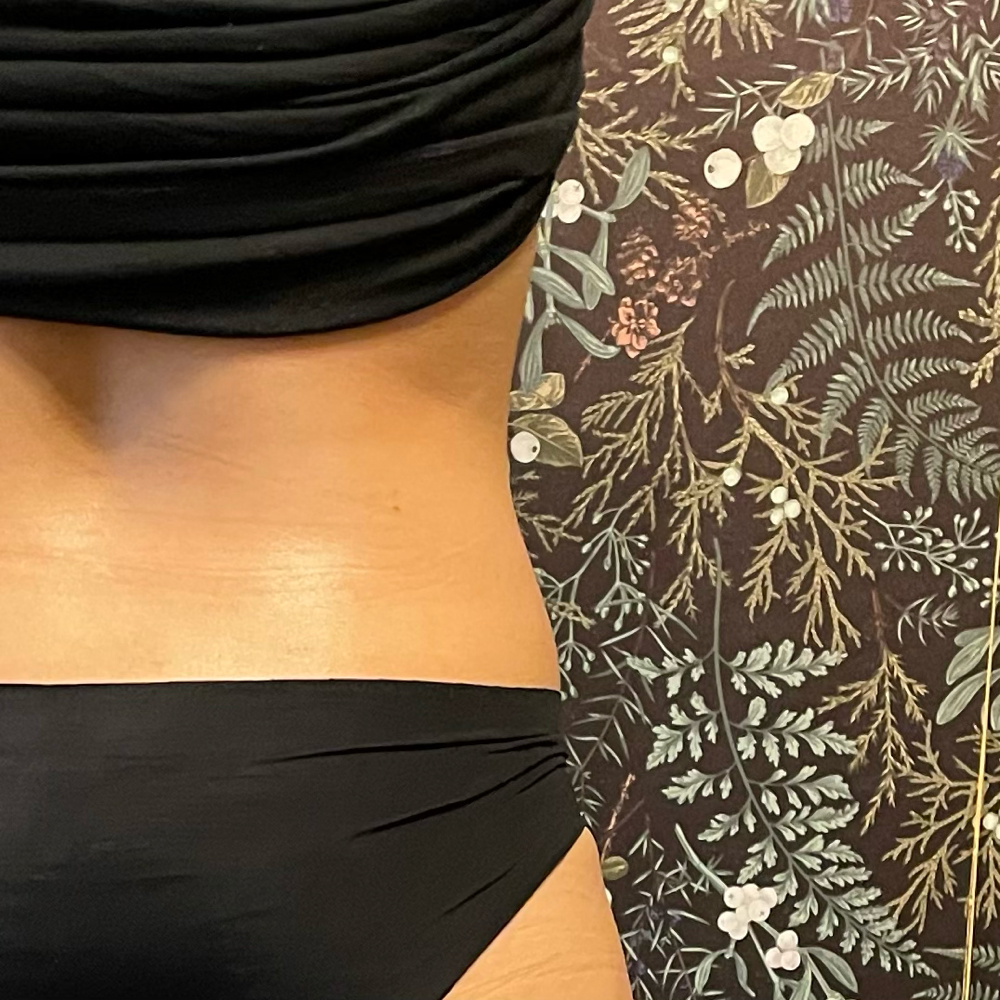 “Love Handles” Fat Dissolve