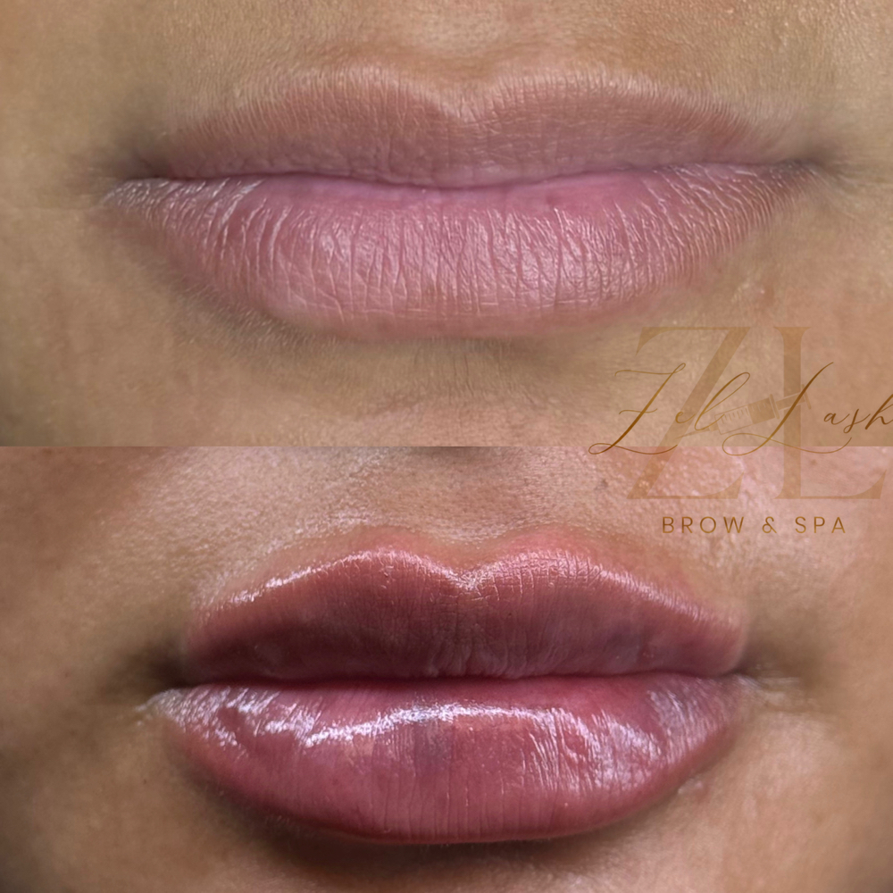 Lip Filler