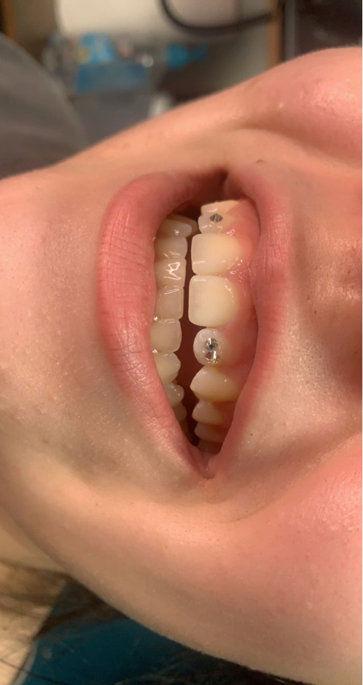 Tooth Gems (18+ ONLY)