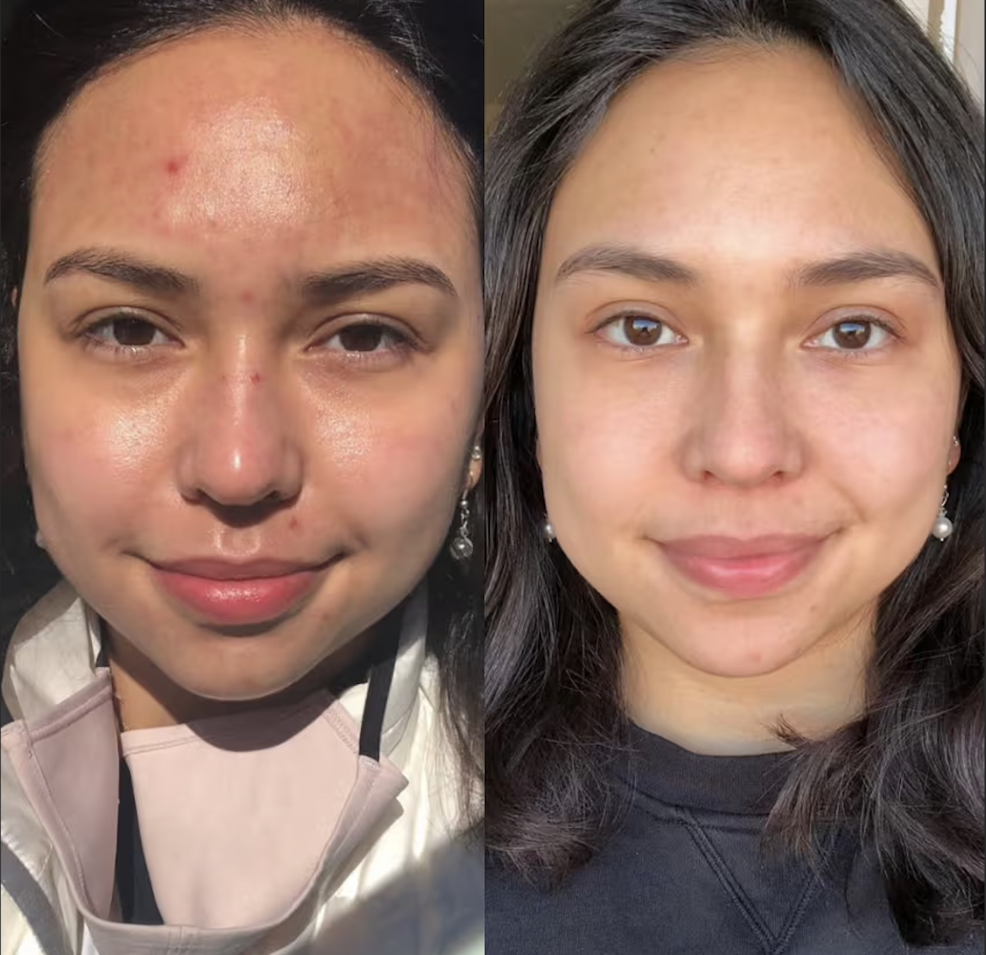 Microneedling