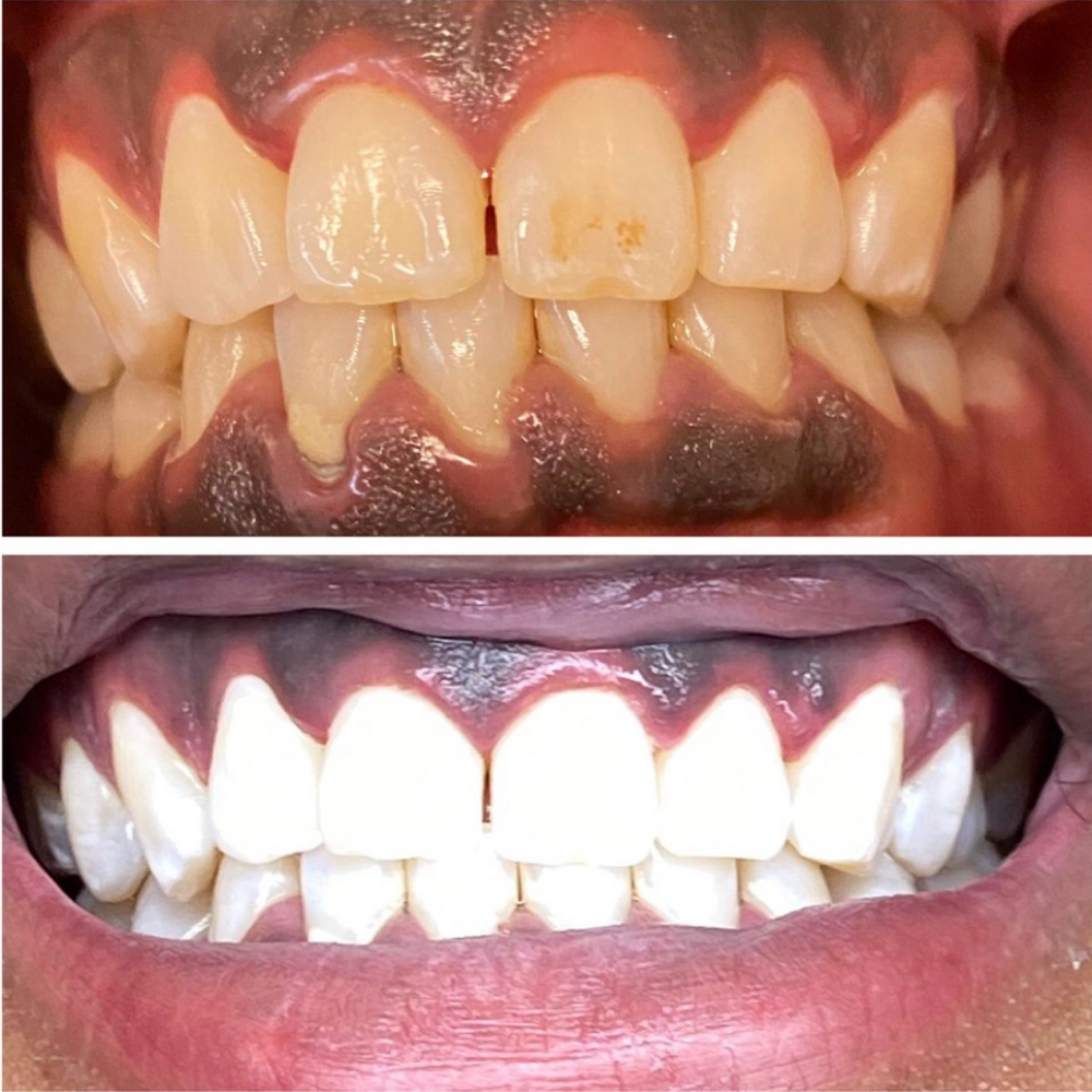 ✨Plaitnum Whitening at Golden Luxe Aesthetics in Indianapolis, IN