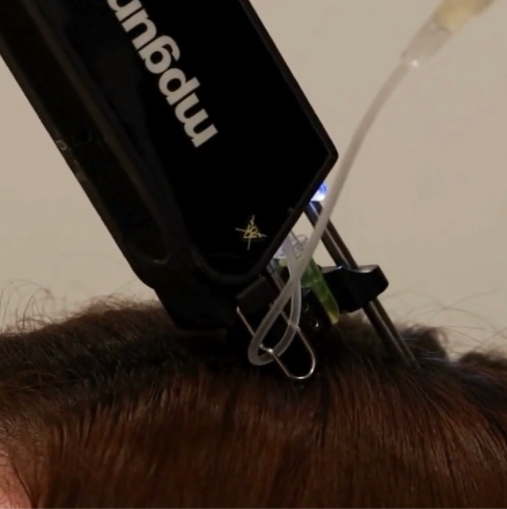 Hair Microneedling with PRP at GlowDerm Clinic in San Jose, CA