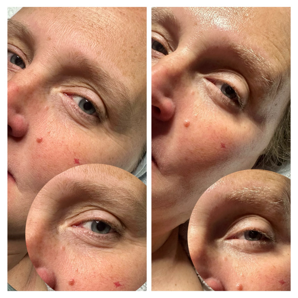 TGIF FACIAL