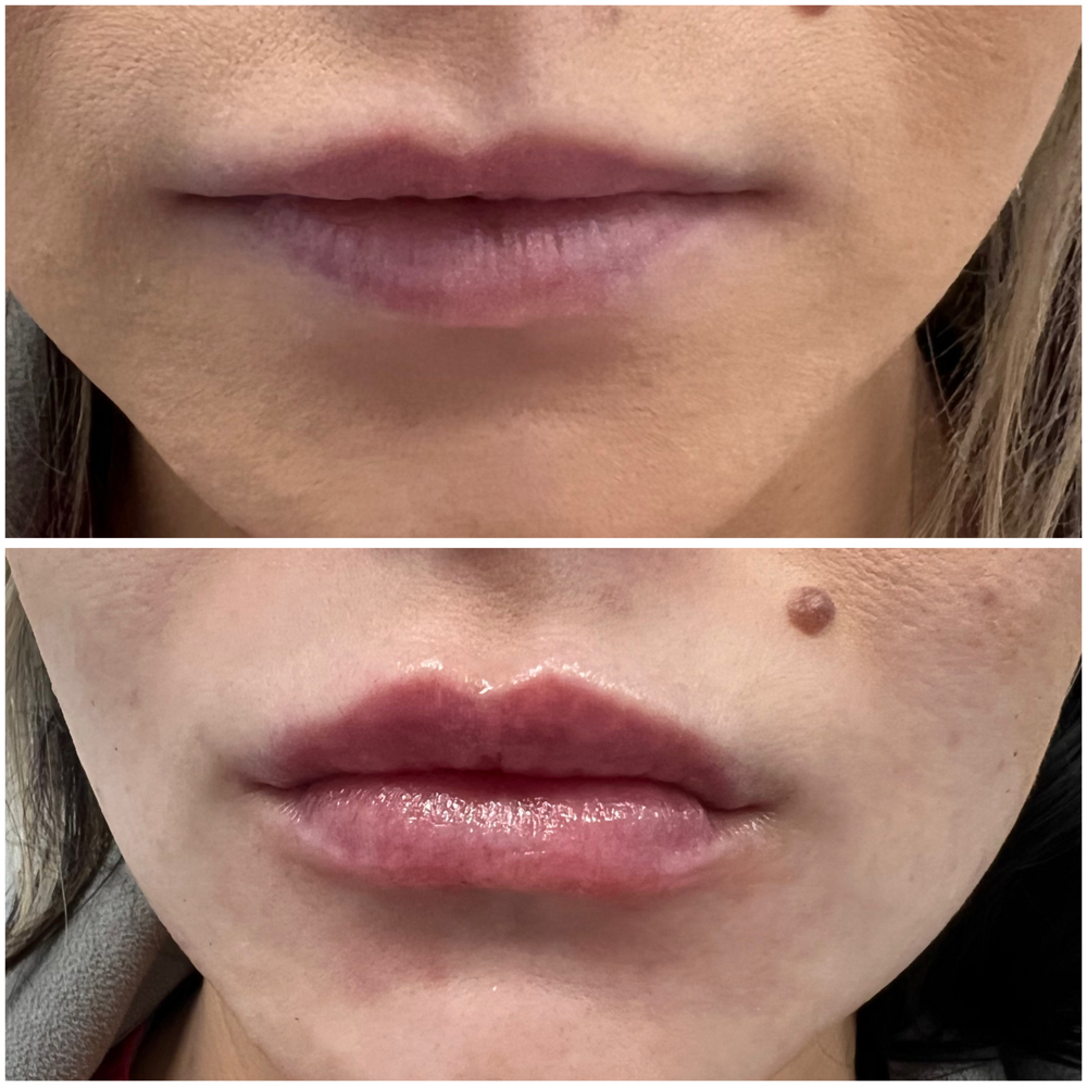 Lip Filler - Half Syringe