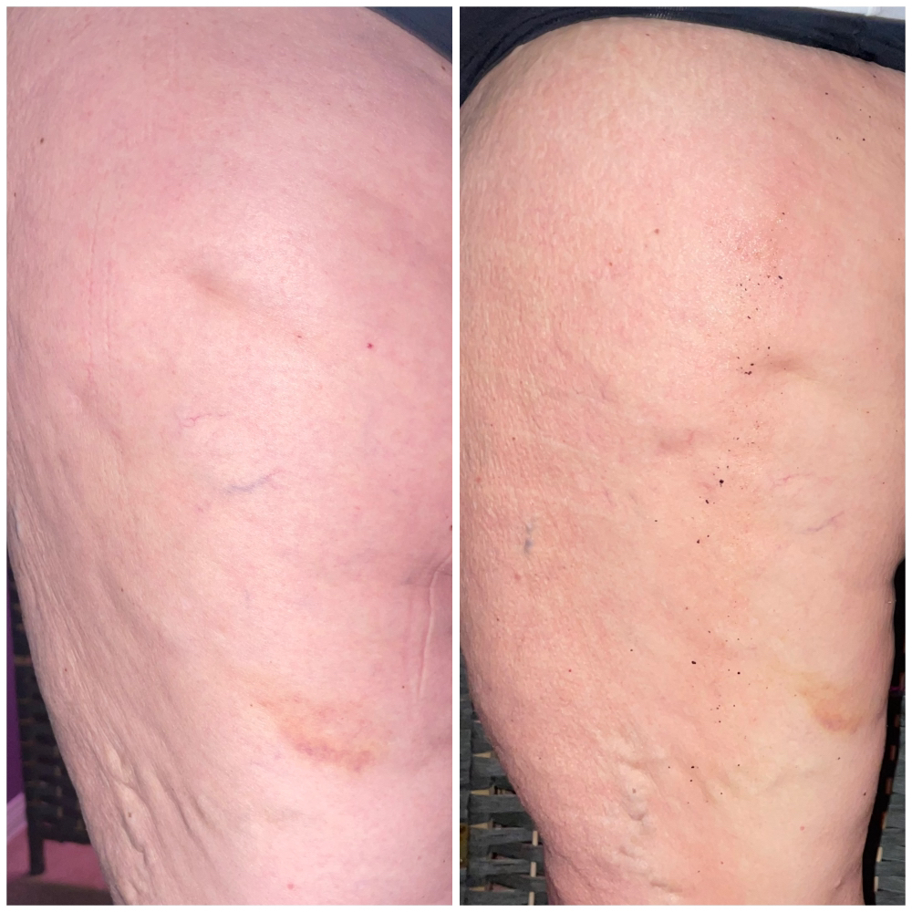 Cellulite Treatment