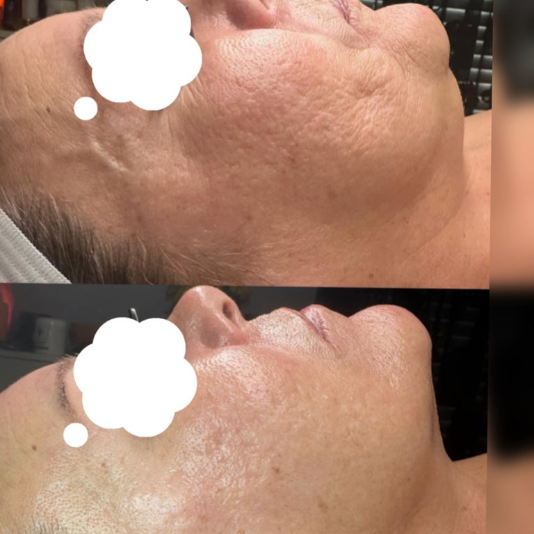 Ageless Power Lift Facial