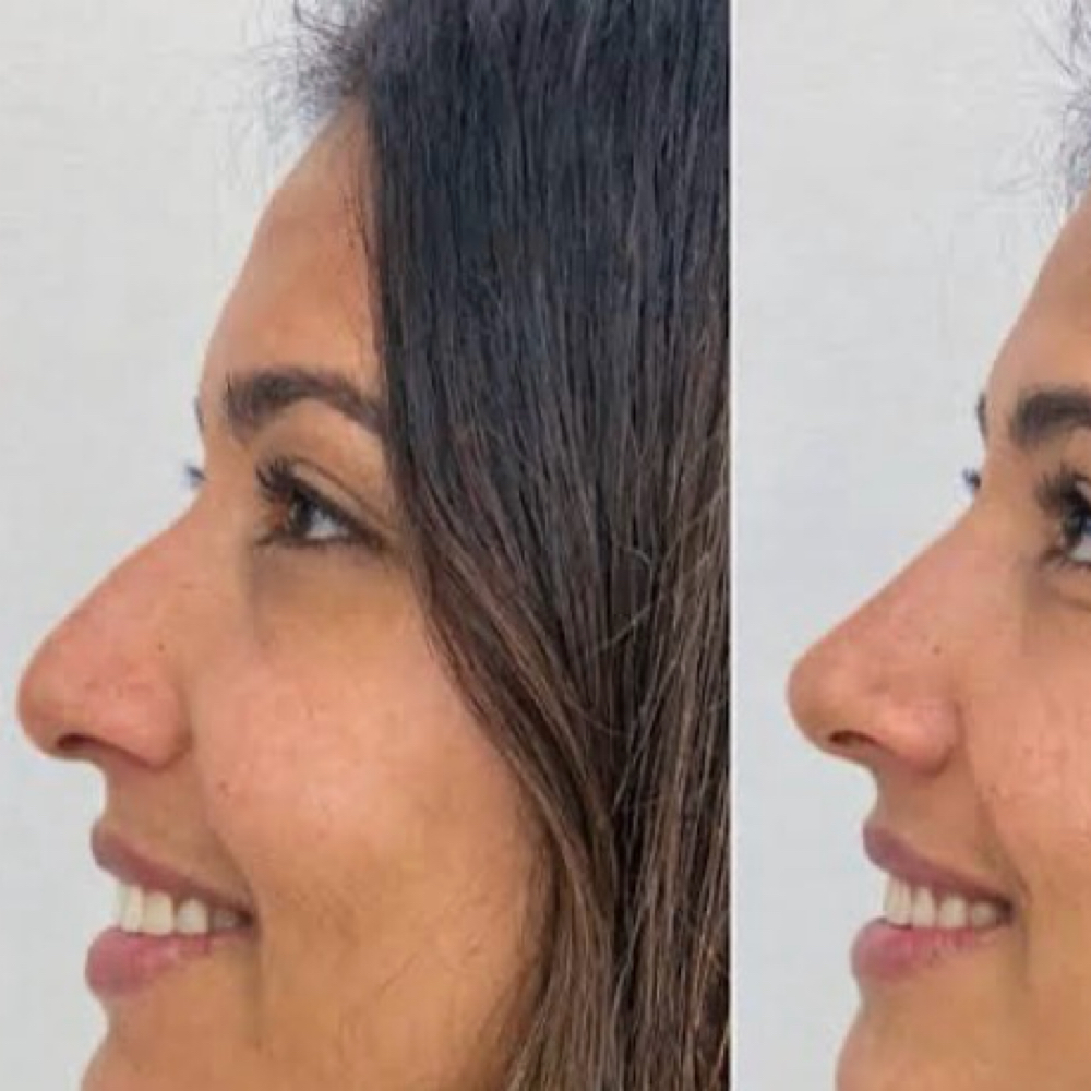 Non-Surgical No Job at Beautified Studios in San Antonio, TX