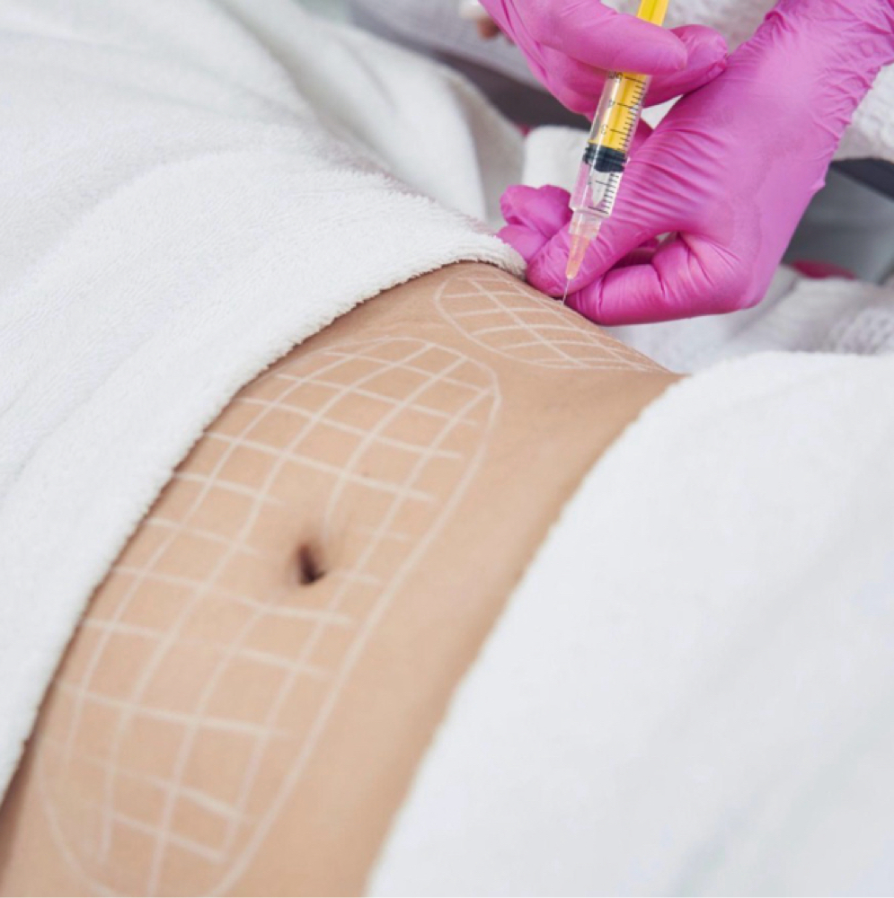 Fat Dissolving at Benlux Aesthetics in Alexandria, VA