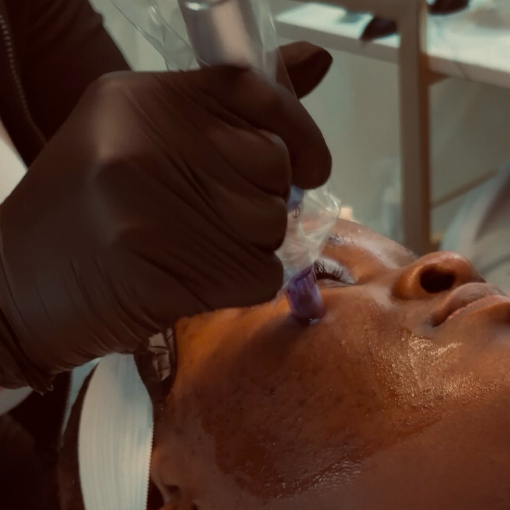 Microneedling at Skin by Amile in Oxon Hill, MD