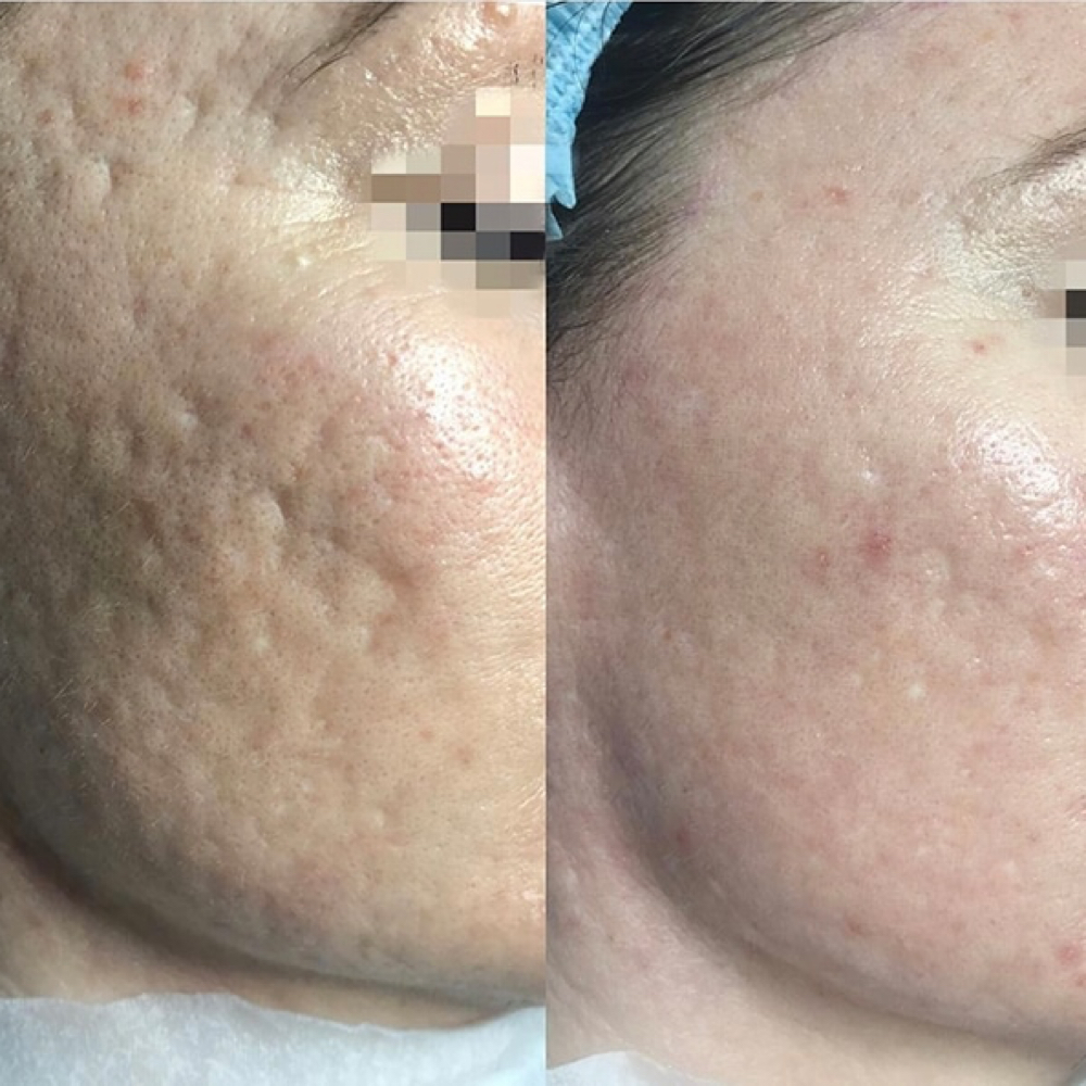 Erbium at ARock Beauty & Wellness in San Angelo, TX