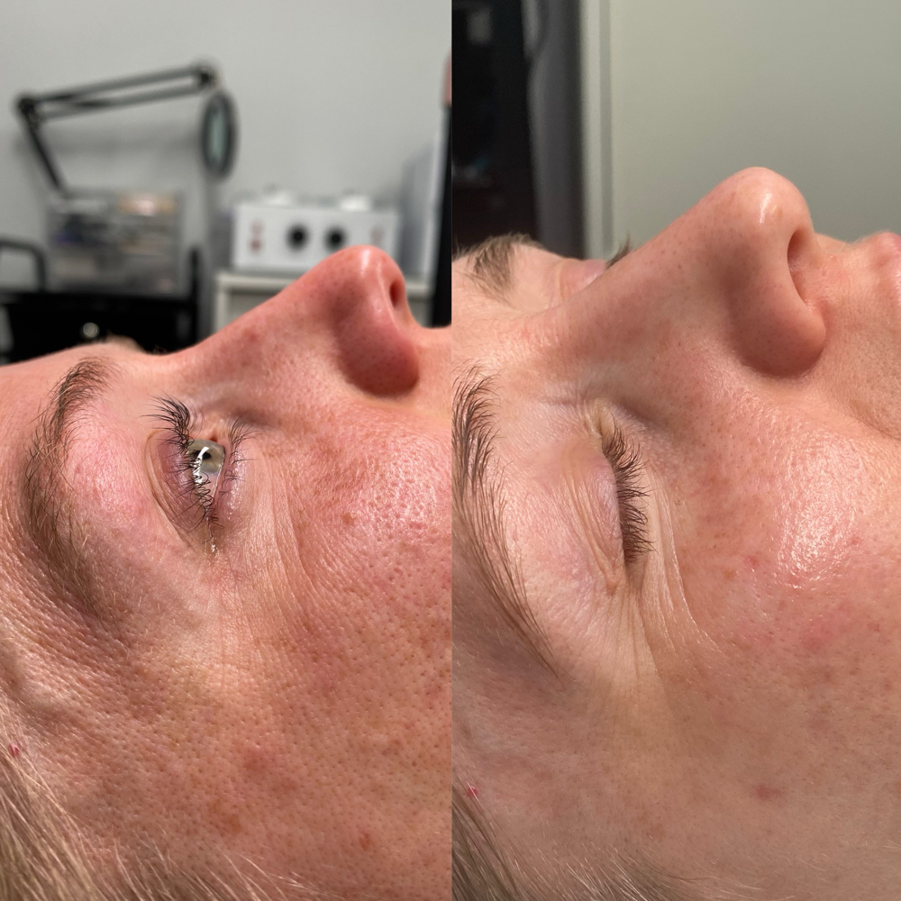 Custom Chemical Peel