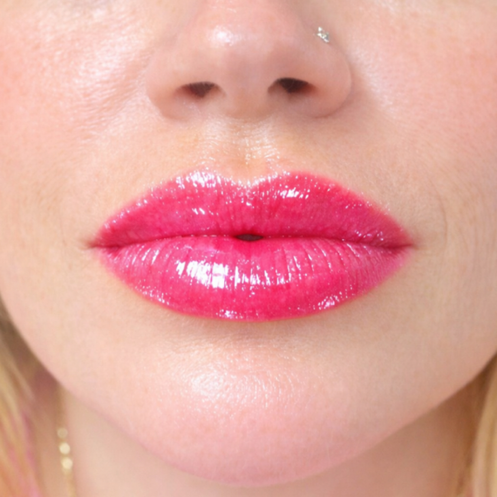 Full Syringe Dermal Filler at Alt Boutique & Aesthetics | Nurse Injector in Hereford, TX