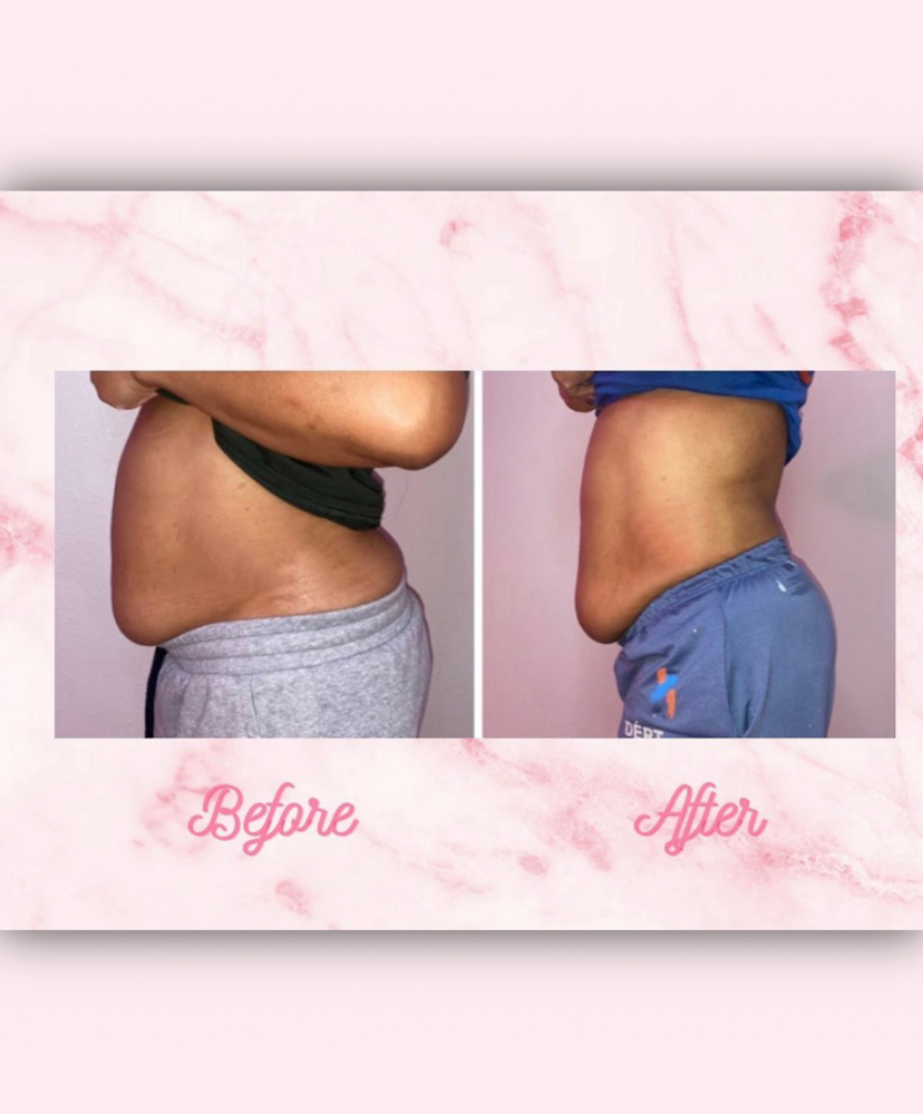 Liposhots Whole Abdomen