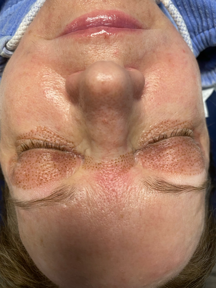 Plasma Fibroblast Frown Lines