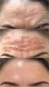 Fibroblast Forehead