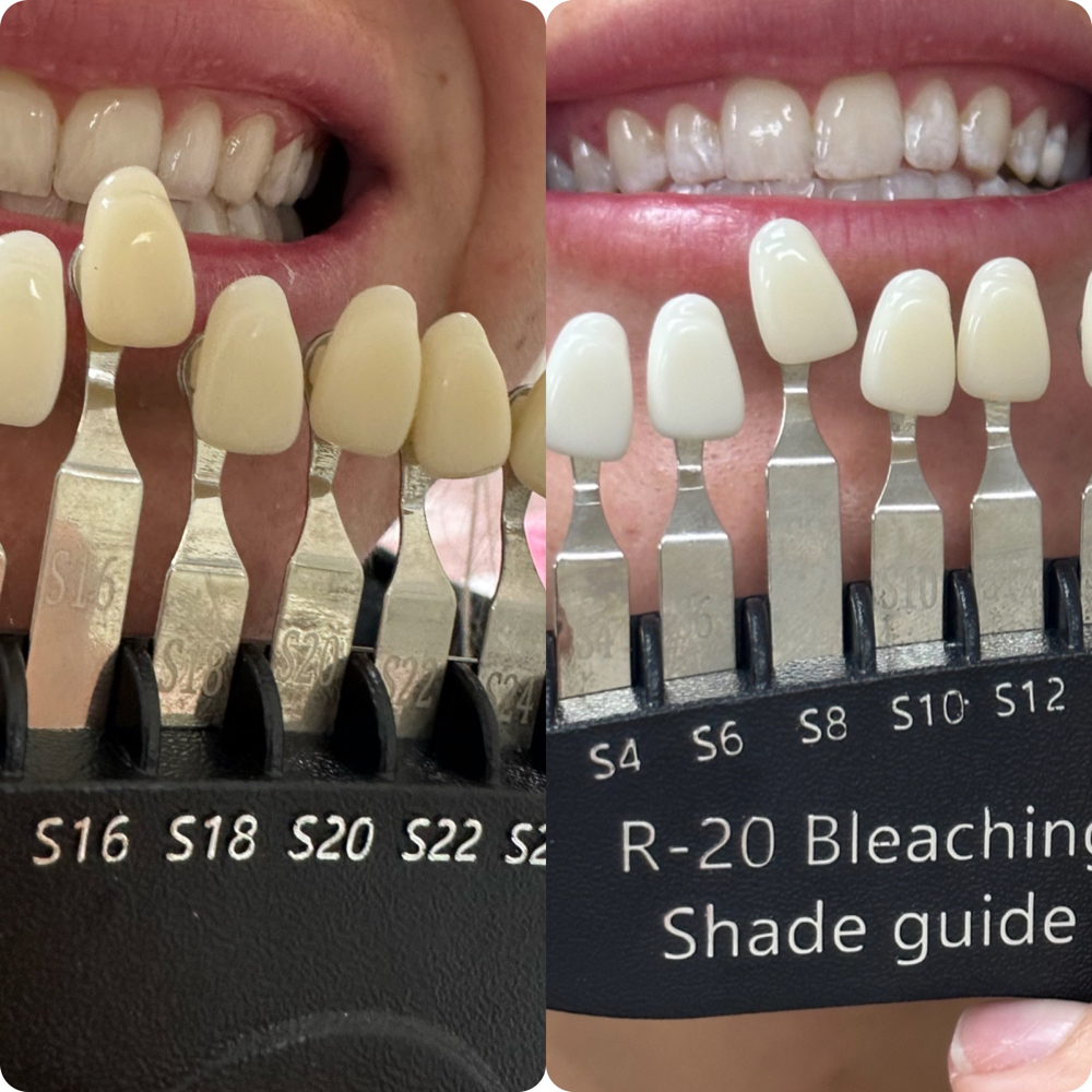 30 Minute Teeth Whitening