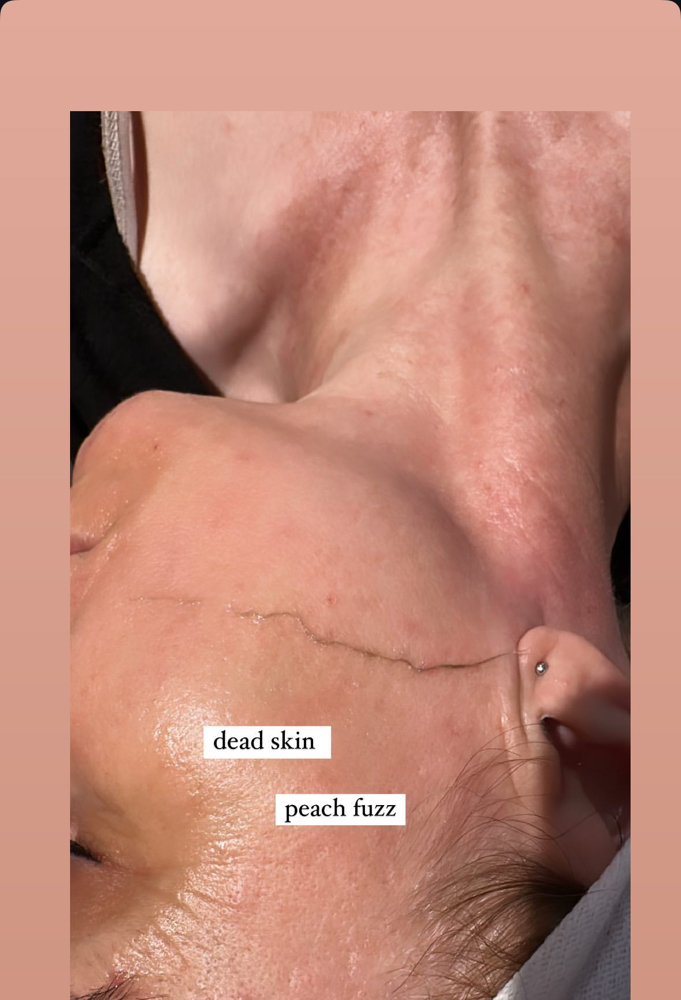 Dermaplane Facial