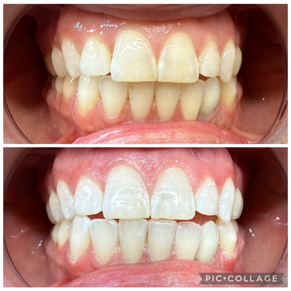 Teeth whitening at Professionally Bright, naturally you! in Midland, MI