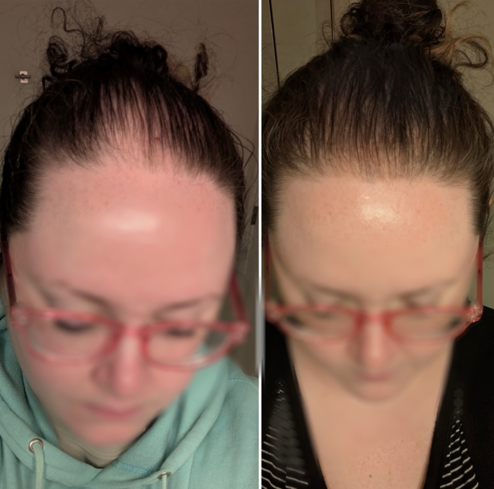 Scalp Micropigmentation W/Alexis