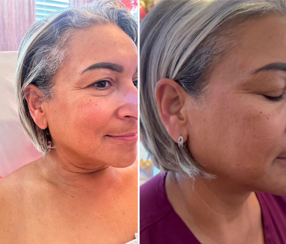 Lipo Face Treatment