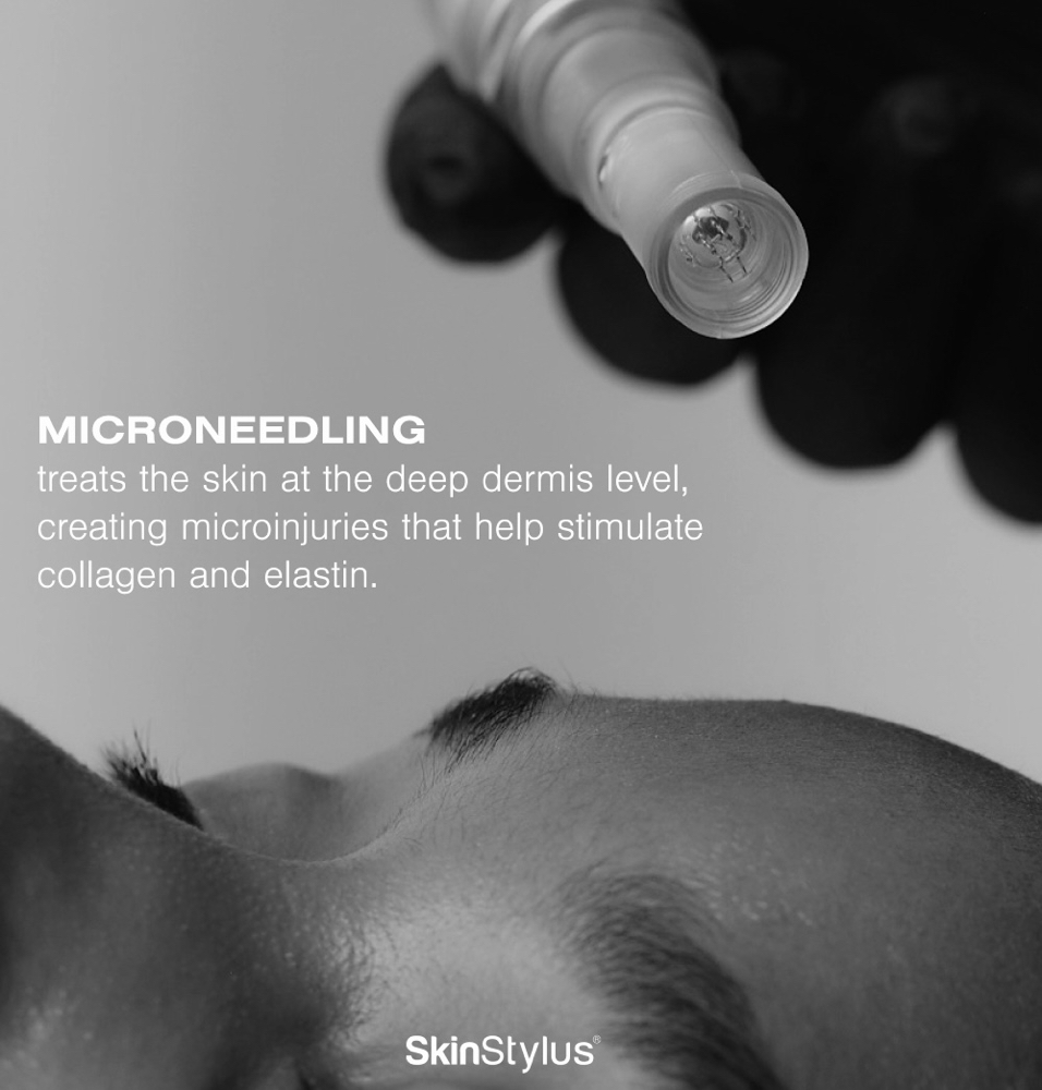 Microneedling