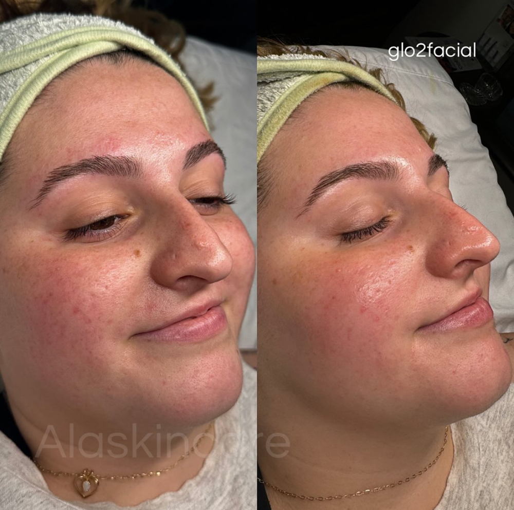 Express Glo2Facial