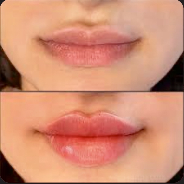 Double The Pout Lip Filler