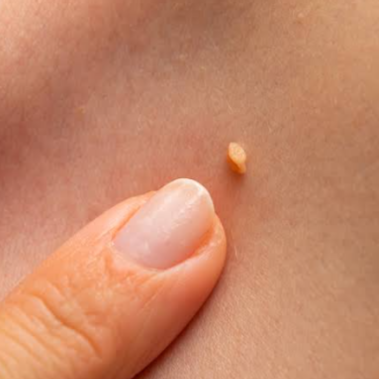 Laser Wart Removal at The Beautee Spot in Phoenix, AZ