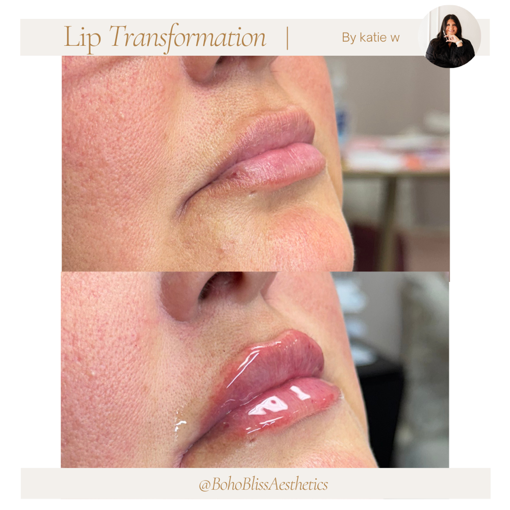 Lip Filler- Full Syringe (1ml)