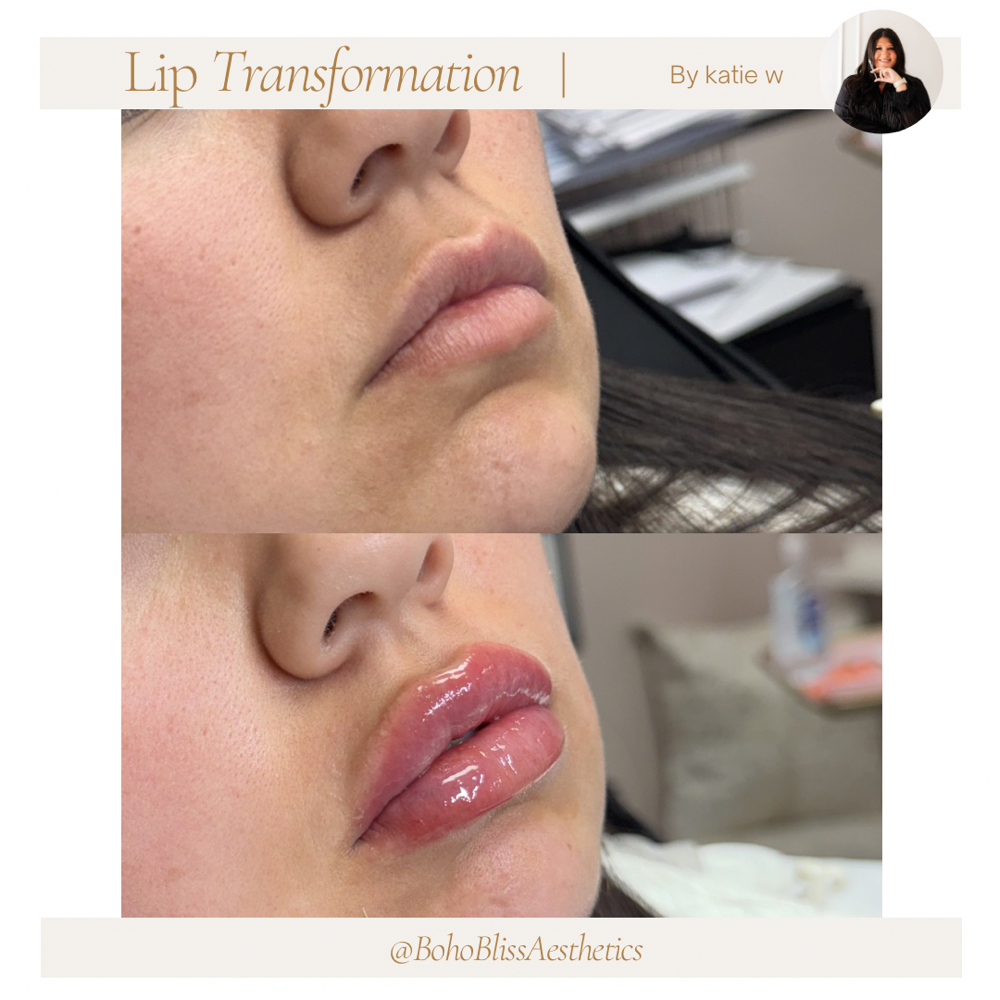 Lip Filler- Full Syringe (1ml) at Boho Bliss Aesthetics LLC in Crosby, TX