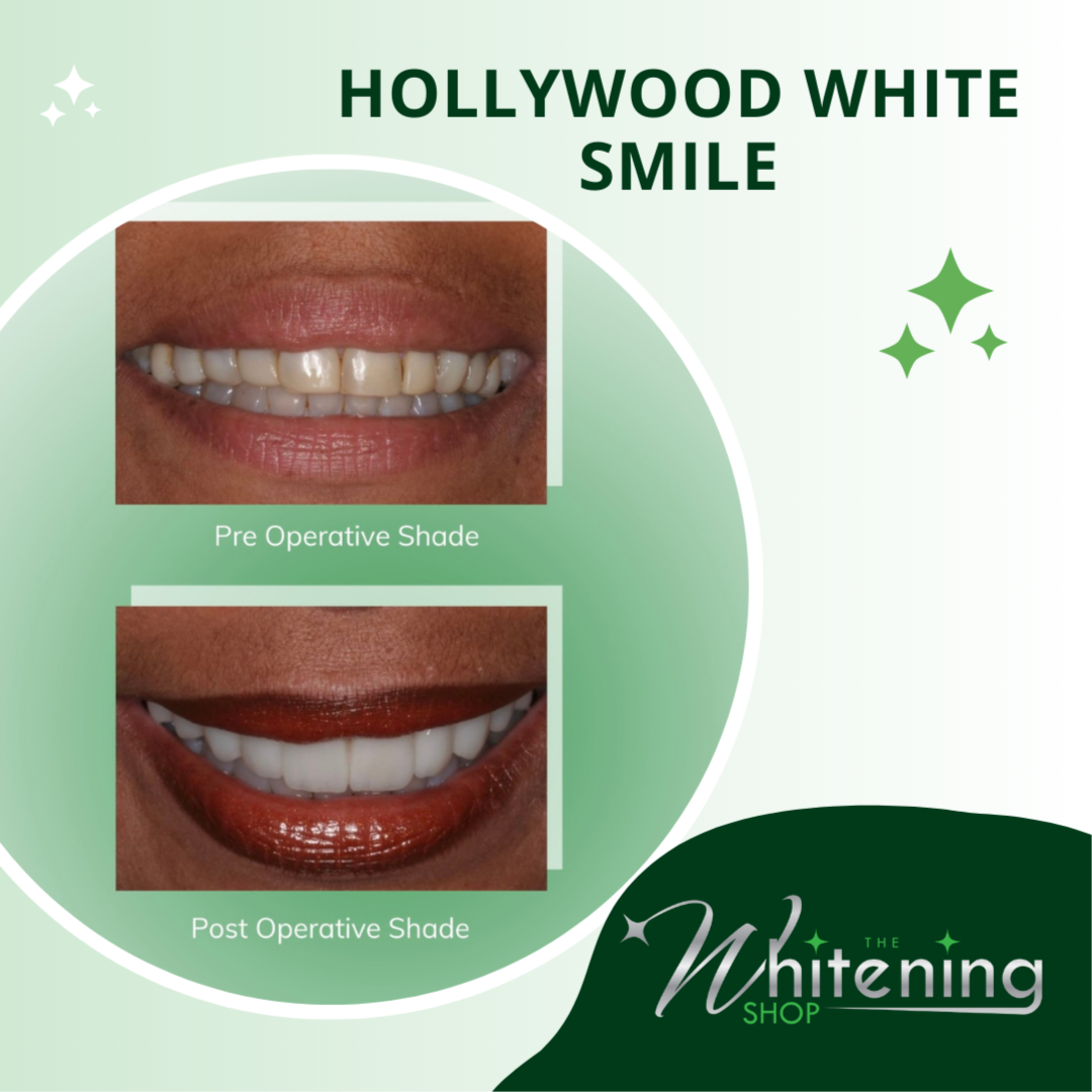 Severe Discoloration Whitening at The Whitening Shop in Virginia Beach, VA