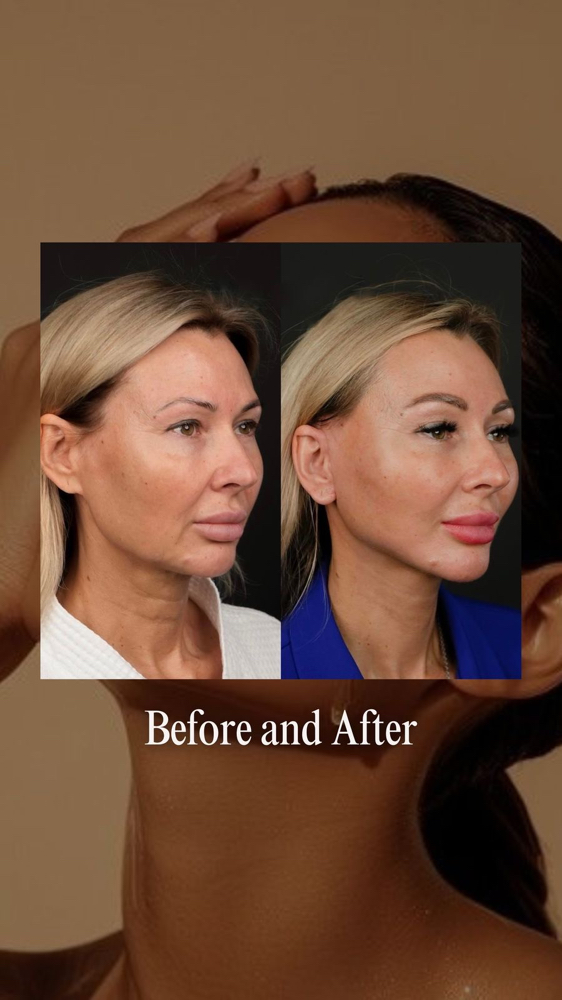 MATRIX Non Surgical Face Lift