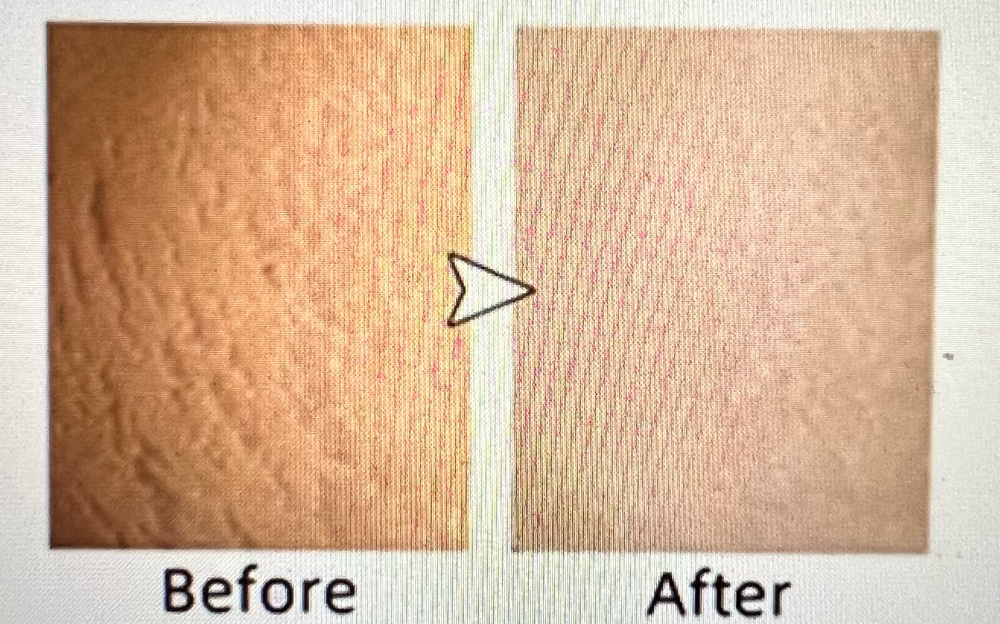 Microneedling