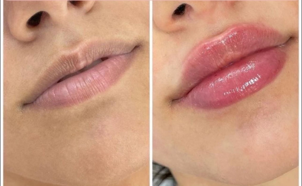 Full Syringe Lip Filler