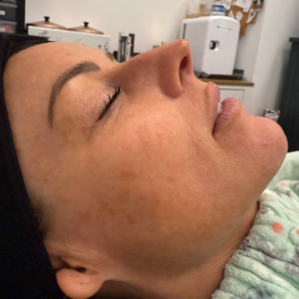 Inkless Sun / Age Spot Rejuvination at Flawless Skin By Sarah in Roseville, CA