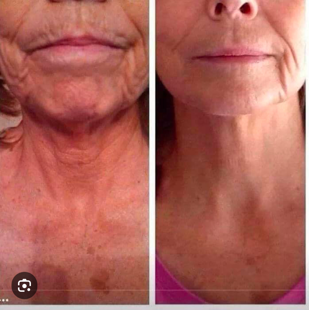 MicroChanneling Face,Neck, Decollet