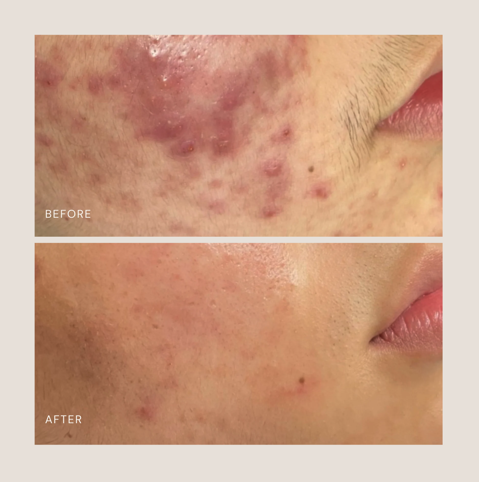 Acne Boot Camp