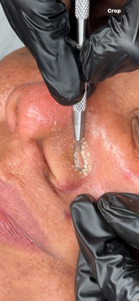 EXTRACTIONS ONLY (TEEN/PRE TEEN)