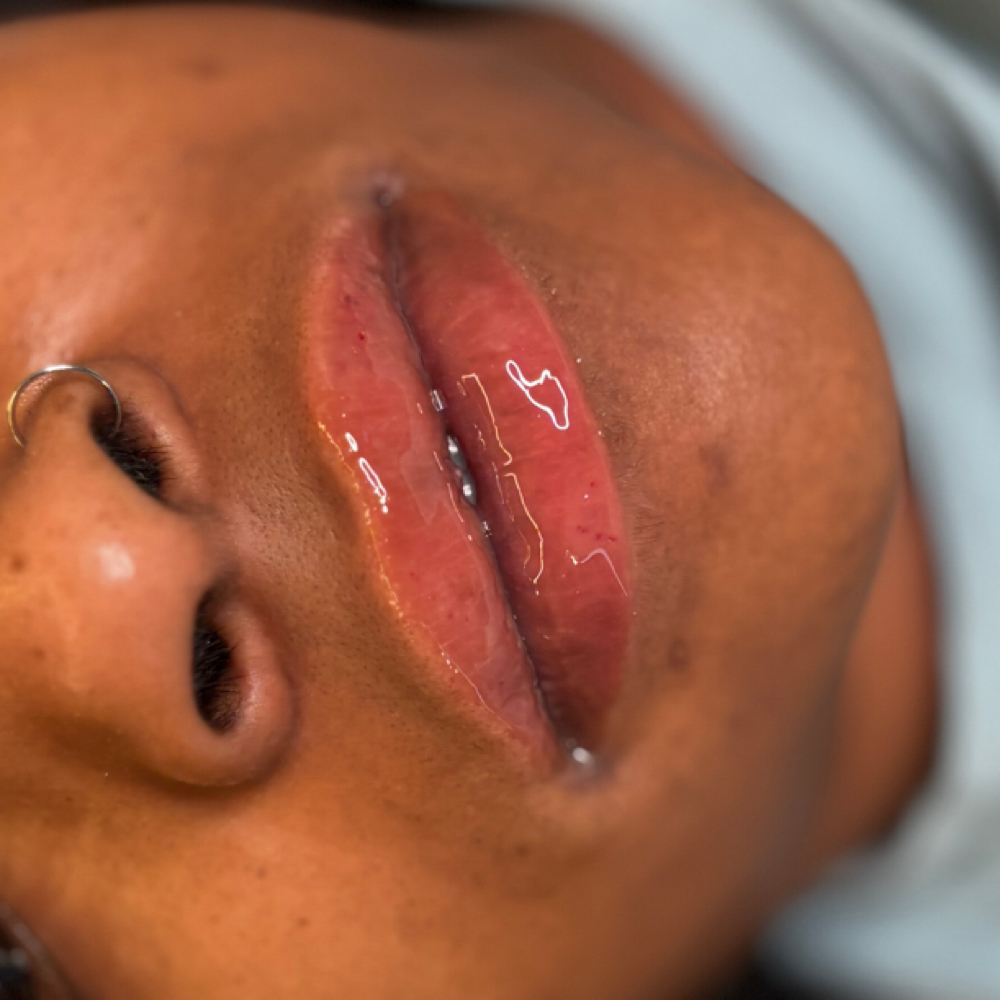 0.5 Needleless Lip Filler at Karisma Beaute Effect in Atlanta, GA