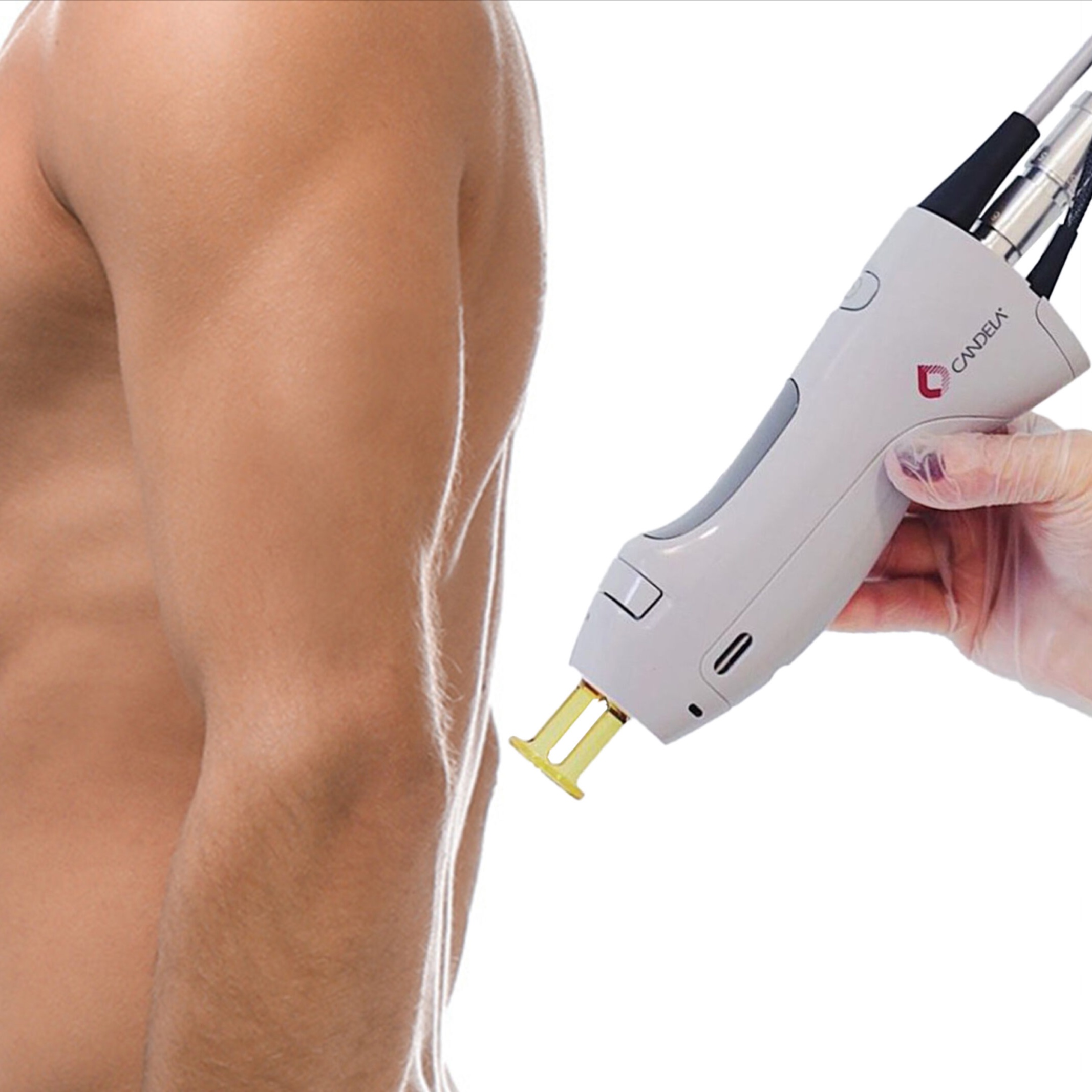 Laser Hair Removal (XL Area)