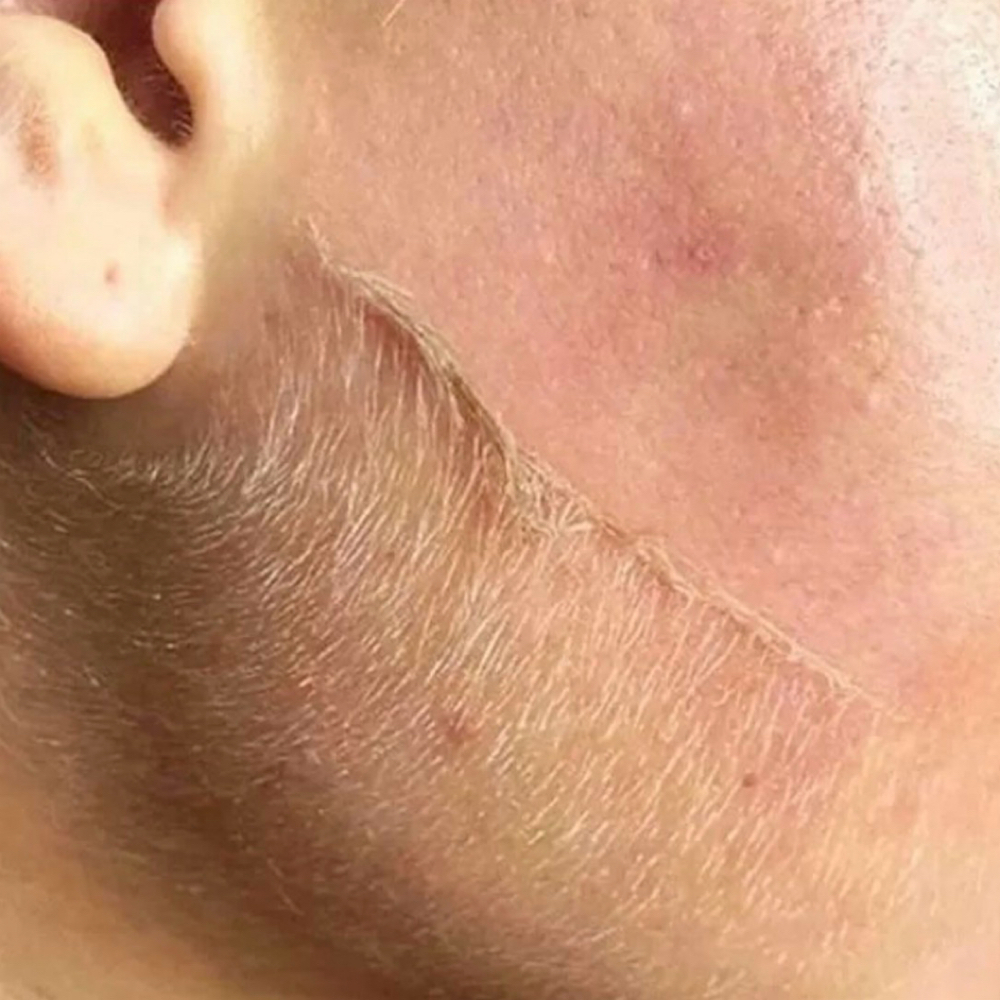 Dermaplaning Facial at Infinity Healing Spa & Wellness in Lansing, MI