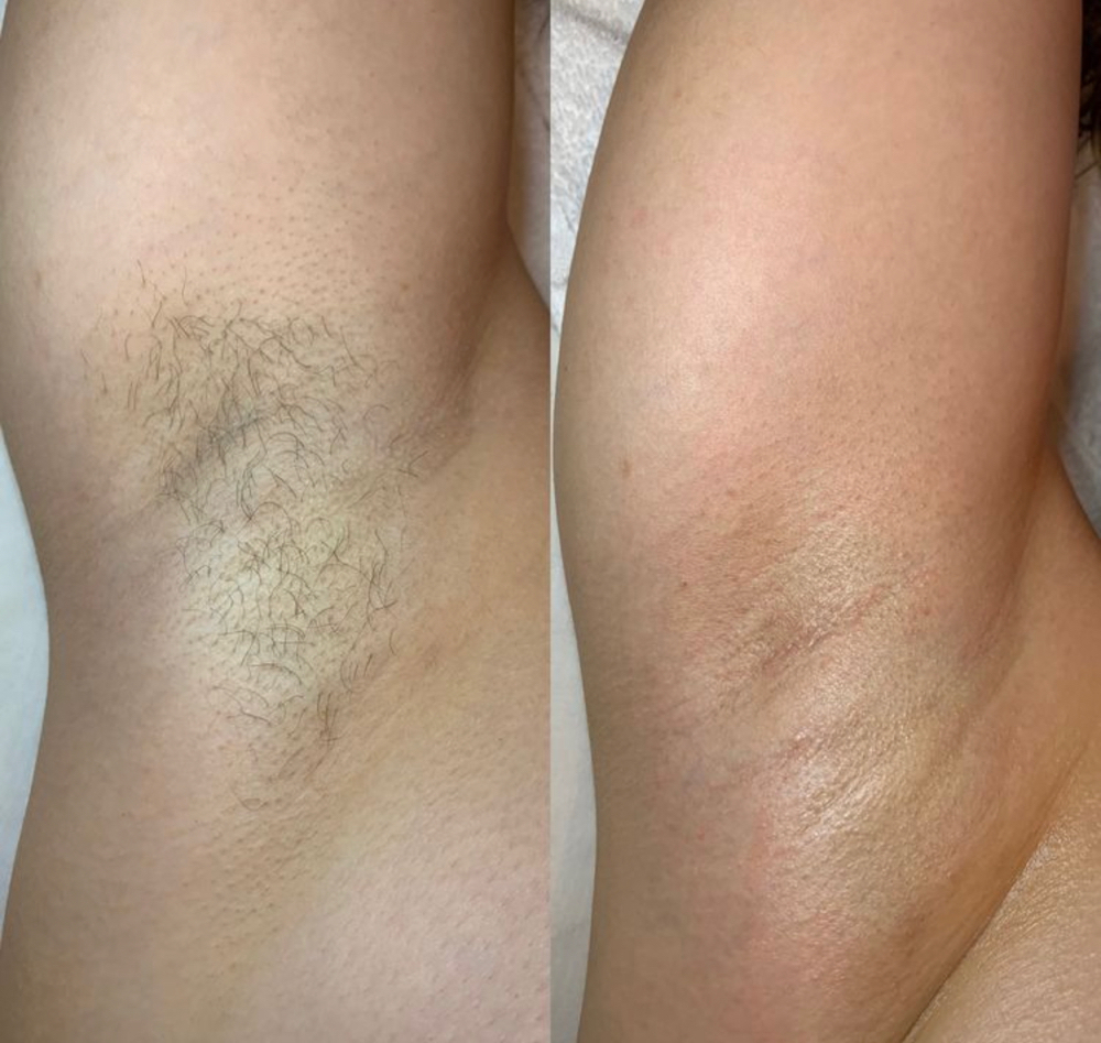 Underarm Wax