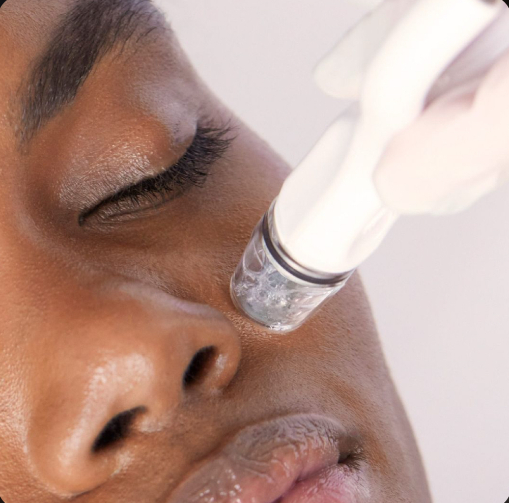 Deep In: Microneedling