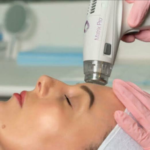 Candela RF Microneedling at Illumina Aesthetics and Laser in Palm Beach Gardens, FL