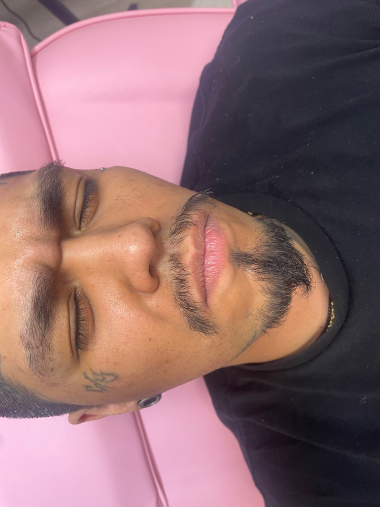 Full Face Botox