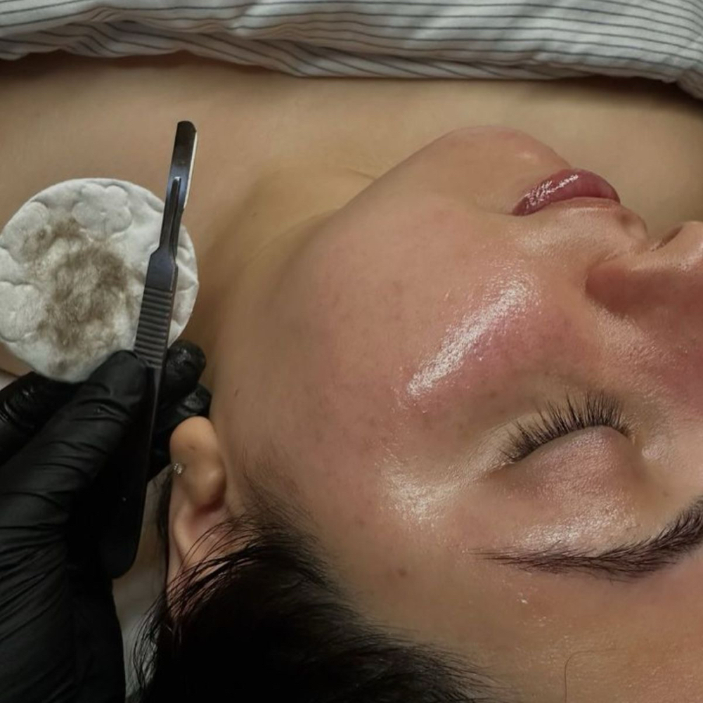 Dermaplaning at Cox Clinic & Aesthetics in Antlers, OK