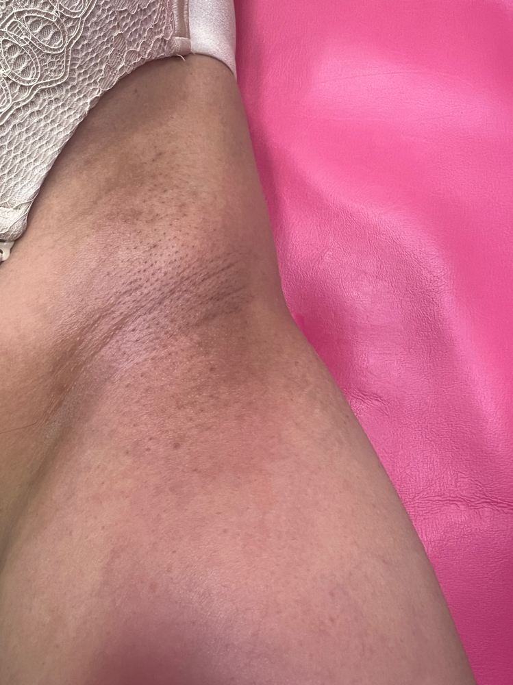 Waxing - Underarms